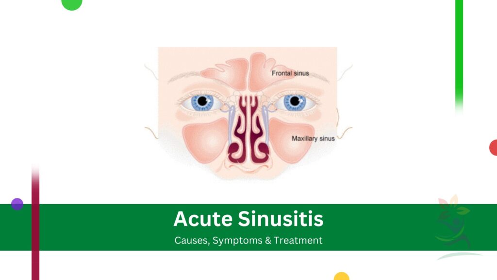 Acute Sinusitis